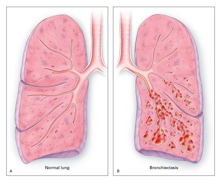 BRONKIEKTASIS TERINFEKSI PADA BEKAS TB