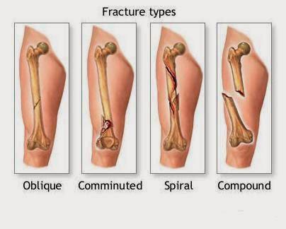 CLOSE FRAKTUR 1/3 MEDIAL FEMUR DEXTRA