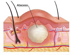 Abses Inguinal