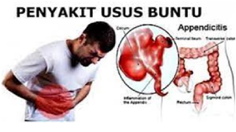 Penyakit Usus Buntu